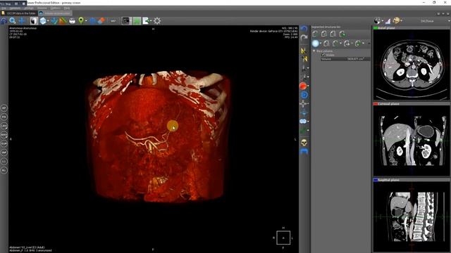 Exporting the surface of a 3D model using Inobitec DICOM Viewer Pro Edition смотреть онлайн