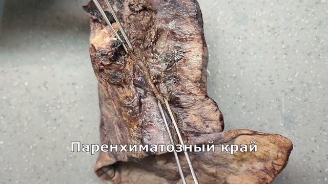 Рак легкого #2 - центральный рак легкого смотреть онлайн