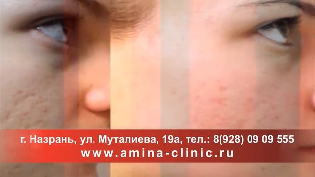 лазерная эпиляция удаление волос, шрамов, растяжки, сосудистые звездочки