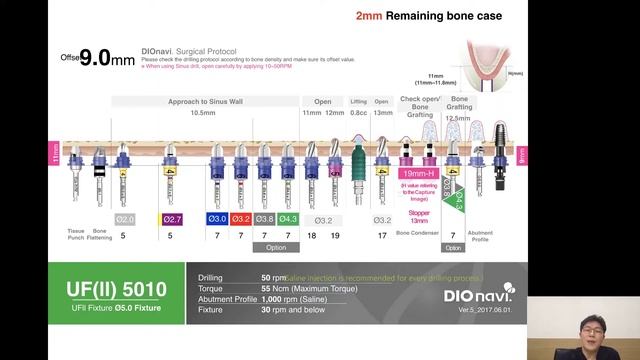 How to overcome the sinus with DIOnavi guided implant solution by Dr. Kang Jaeseok смотреть онлайн