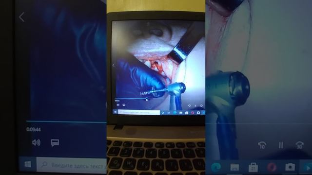 Удаление 23 зуба. с одномоментной установкой имплантов.Экранный кейс#2. смотреть онлайн