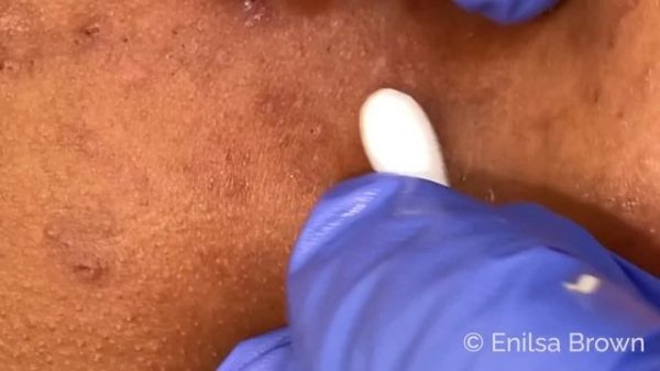 Blackhead Extractions on Netty - Fifth Treatment