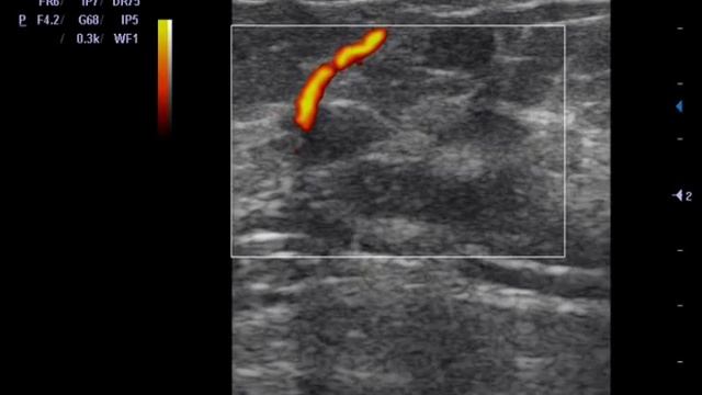 Образования молочной железы смотреть онлайн