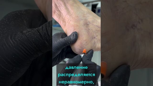 Обработка трещин / НОГИМЕД