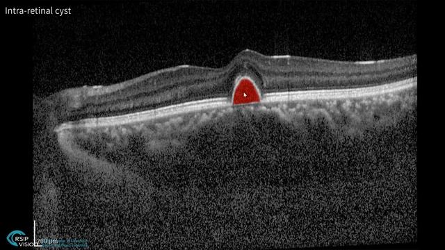 One-click segmentation in medical imaging - by RSIP Vision смотреть онлайн