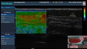Эластография  молочной железы. Практическое занятие на фантоме