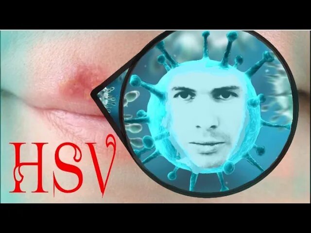 ПРОСТОЙ ГЕРПЕС...в стихах и не только.mp4 смотреть онлайн