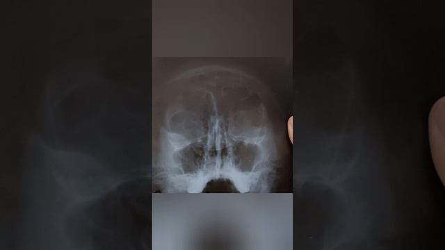 Фронтит без уровня жидкости на рентгеновском снимке. смотреть онлайн