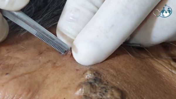 Comedão (Comedone) - Ep 01 (cravos gigantes)