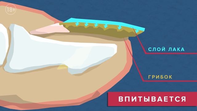 Как правильно выбрать средство от грибка? смотреть онлайн