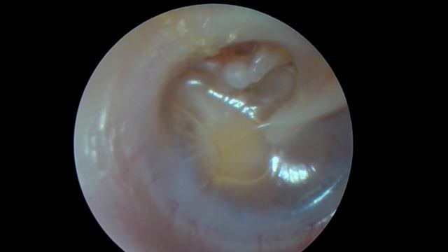 Exudative and chronic otitis, 9 years - Ексудативний та хронічний отит, 9 років смотреть онлайн