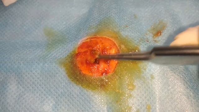 BEST Pimple Popping // Big Cystic Acne Blackheads // Whiteheads Removal  // Squeezing Pimples #025