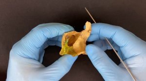 Верхняя челюсть - Maxilla (анатомия человека)