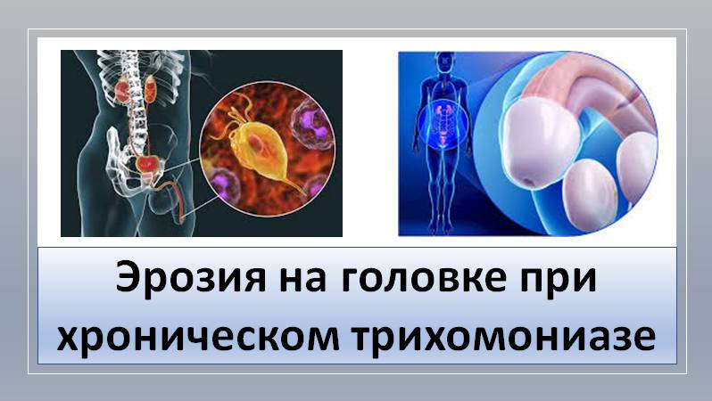 Эрозия на головке при хроническом трихомониазе смотреть онлайн