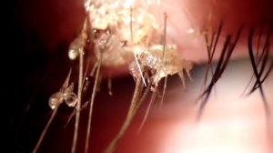 Лобковая вошь