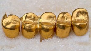 Металлические коронки | Лучшие сплавы и худший выбор для зубов