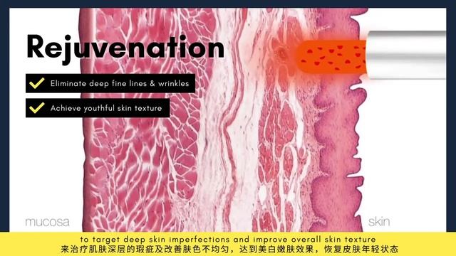 Fotona4D Laser Face Lift 欧洲之星激光 | Sagging Skin Treatment | V Medical Aesthetics Laser Clinic смотреть онлайн