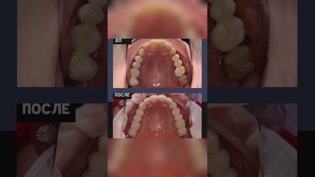 Можно ли ставить импланты при сахарном диабете? Отвечает ЧЛХ Доктор медицинских наук Давид Назарян. смотреть онлайн