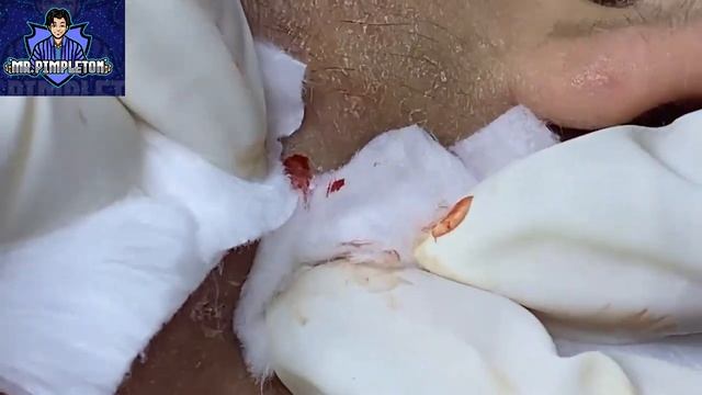 Cystic Acne Treatment / Cyst and Blackhead extraction / Pimple Popping / Clogged Pores #2 смотреть онлайн