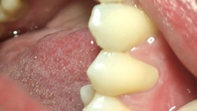 Encontrei um TÓRUS PALATINO durante a LIMPEZA DENTAL e tinha infiltração na RESTAURAÇÃO DE DENTE смотреть онлайн