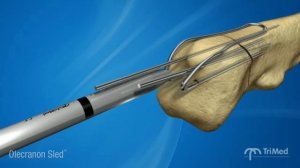 Остеосинтез локтевого отростка по Веберу.