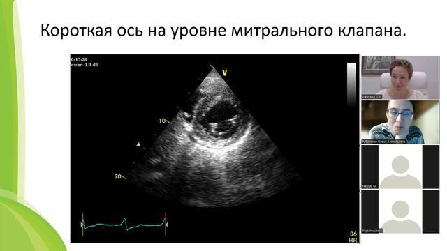 ГиП занятие 2 - зоны сократимости ЛЖ
