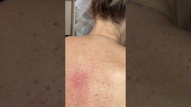 Blackheads! Угри , глубокие чёрные точки на спине . Удаление . смотреть онлайн