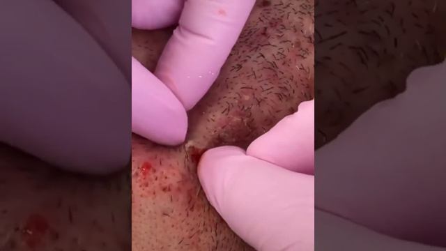 Чистим лицо а вовнутир гной😳😳😳😳💉💉💉💉💉💉 смотреть онлайн
