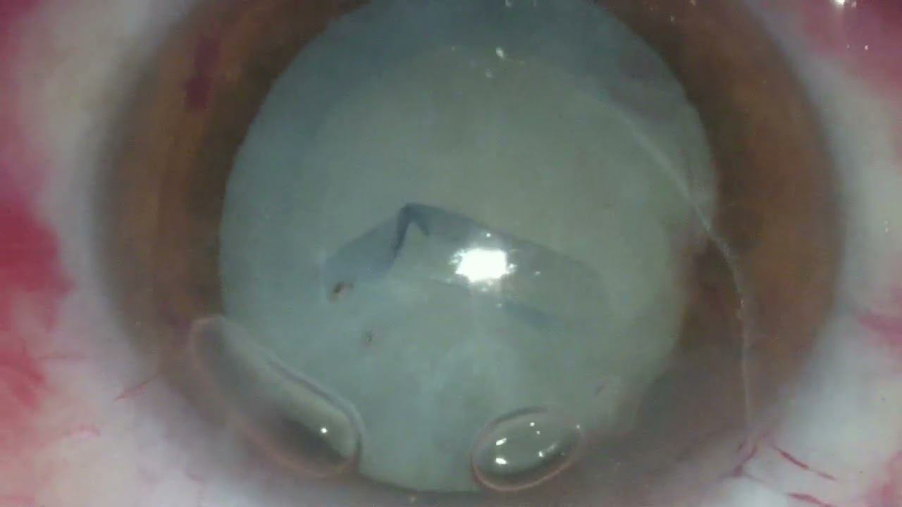 4.4 Травматическая катаракта