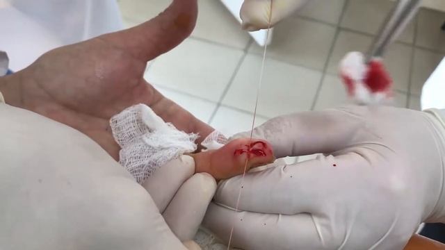 ПИОГЕННАЯ ГРАНУЛЕМА | ИССЕЧЕНИЕ И НАЛОЖЕНИЕ ШВОВ