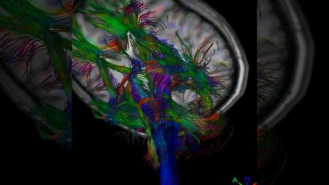 Mapping Neural Advanced Imaging Neurology.#DTI #MRI #BrainMapping #Neuroscience #AdvancedImaging" смотреть онлайн