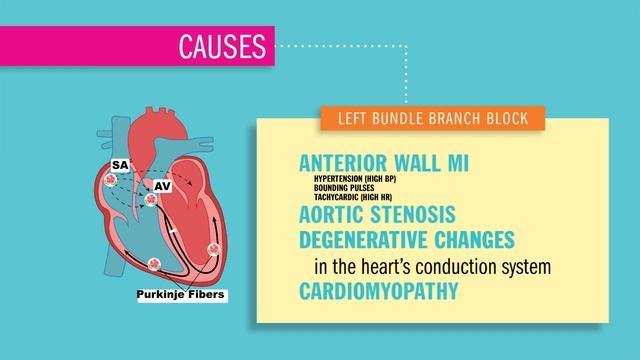 EKG l Bundle Branch Block смотреть онлайн