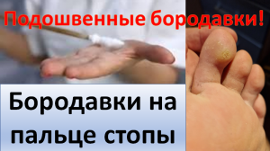 Бородавки на пальце стопы