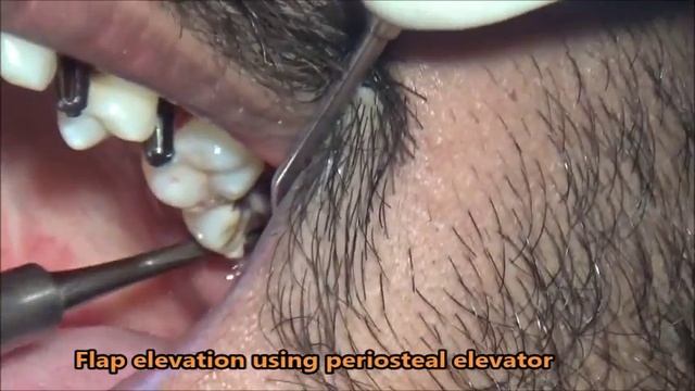 How to use cryers elevator to extract upper wisdom tooth смотреть онлайн