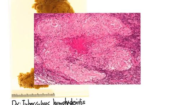 Lymphadenopathy TB vs Lymphoma смотреть онлайн