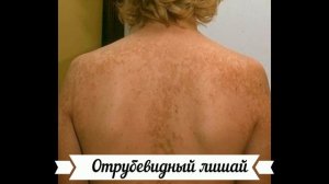 Лишай у человека: фото и симптомы