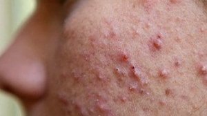 Почему возникает фурункулез и как его лечить