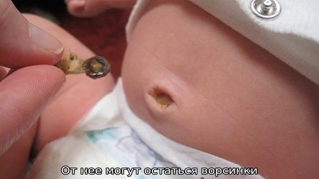 Пупок у новорожденного — сроки заживления пупочной ранки смотреть онлайн