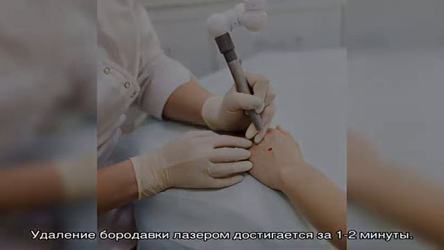 Удаление бородавок лазером - цены в Москве смотреть онлайн