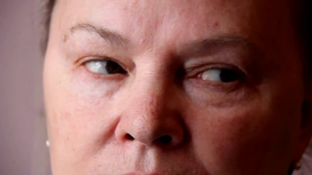 Вертикальный нистагм при повреждении мозжечка. смотреть онлайн