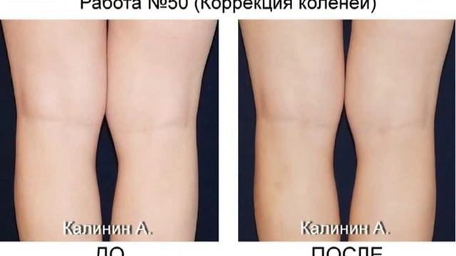 ПЛАСТИКА ДО И ПОСЛЕ ФОТО смотреть онлайн