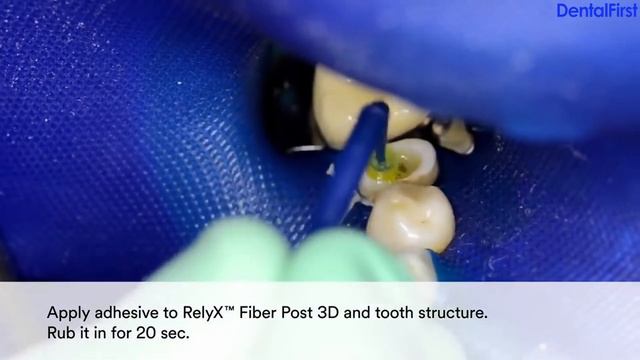 RelyX Fiber Post смотреть онлайн