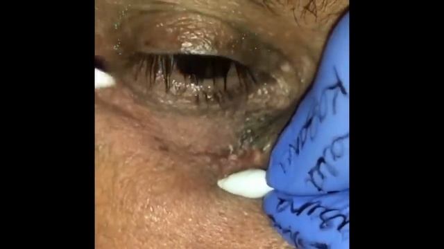 Stubborn Blackheads