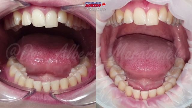 Динамика 6 месяцев лечения на репозиционной шине. Сплинт, ортотик. Вывих Диска ВНЧС