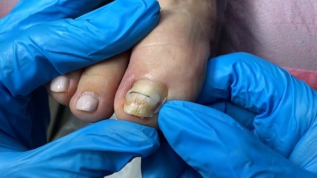 Вросший ноготь на ноге / Грибок ногтей