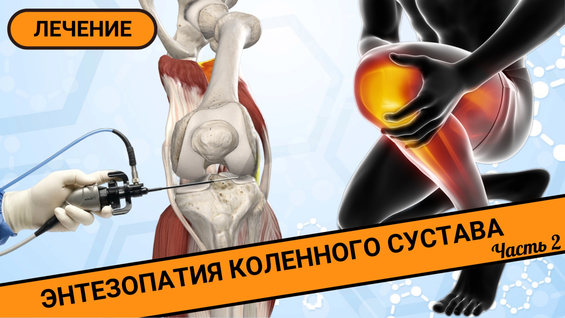 КАК ЛЕЧИТЬ БОЛЬ В КОЛЕНЕ? || Энтезопатия коленного сустава. Лечение. (Часть 2) смотреть онлайн