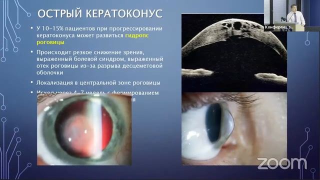 "Патология роговицы. Случаи реальной клинической практики" смотреть онлайн