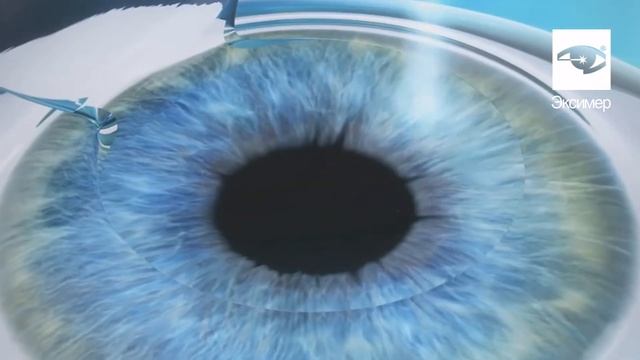 Что такое LASIK? смотреть онлайн