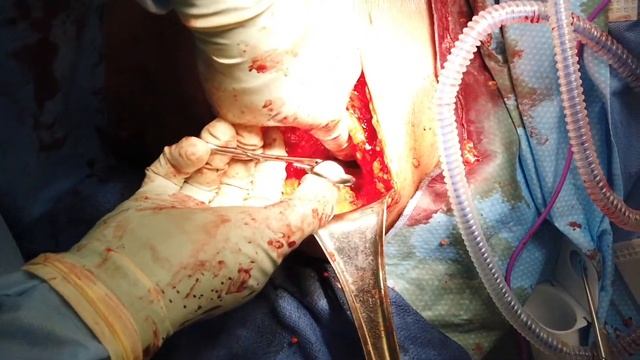 Sentinel Lymph Node смотреть онлайн