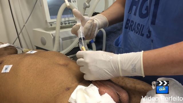 Cateterismo Vesical de Demora - Técnica com Retificação da Uretra смотреть онлайн